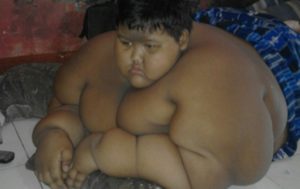 Bocah Obesitas Dirawat di RSHS Bandung item-thumbnail